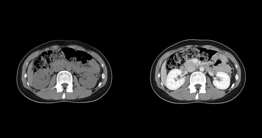 Adrenal Tumor Surgery