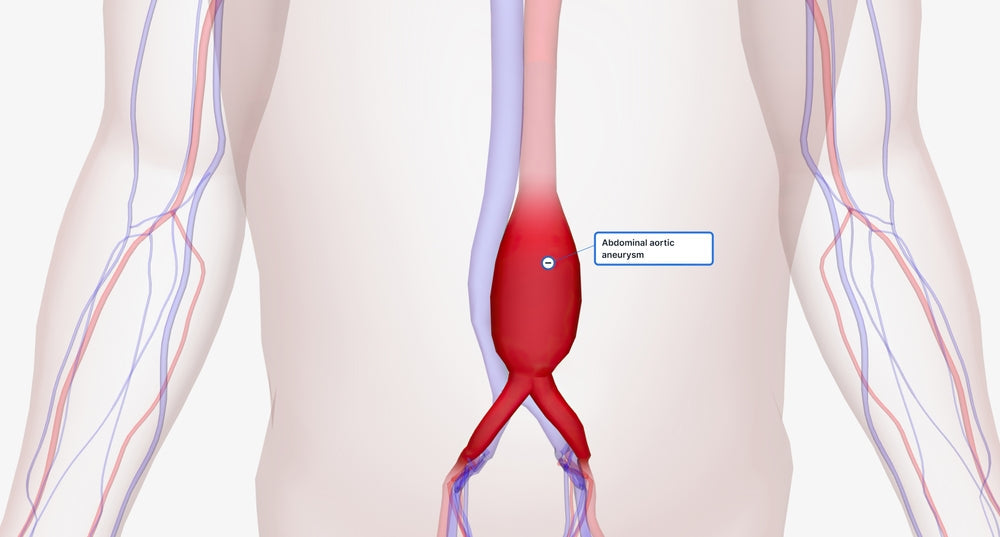 Aortic Aneurysm Surgery: What Patients Really Experience Before and After