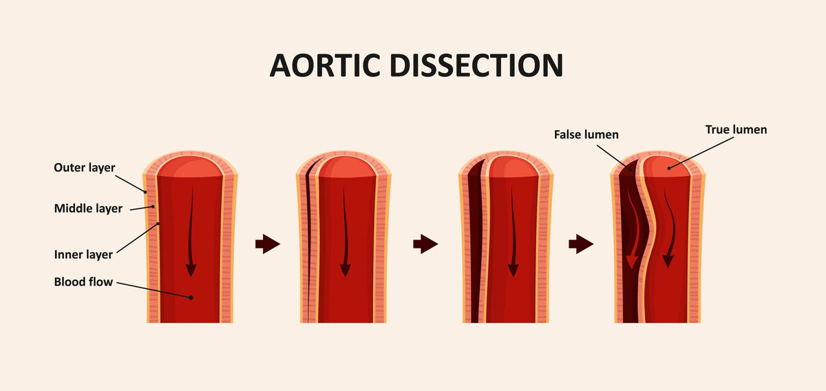 Aortic Dissection Surgery: What Patients Really Experience Before and After