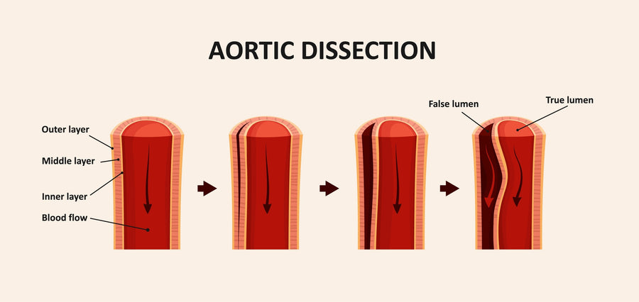 Aortic Dissection Surgery: What Patients Really Experience Before and After