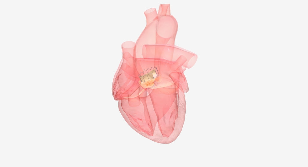 Aortic Valve Replacement: What Patients Really Experience Before and After Surgery