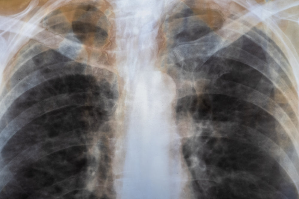 Bone Metastasis Surgery