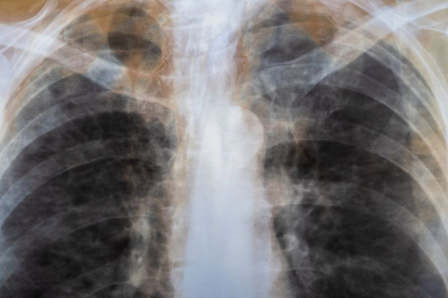 Bone Metastasis Surgery