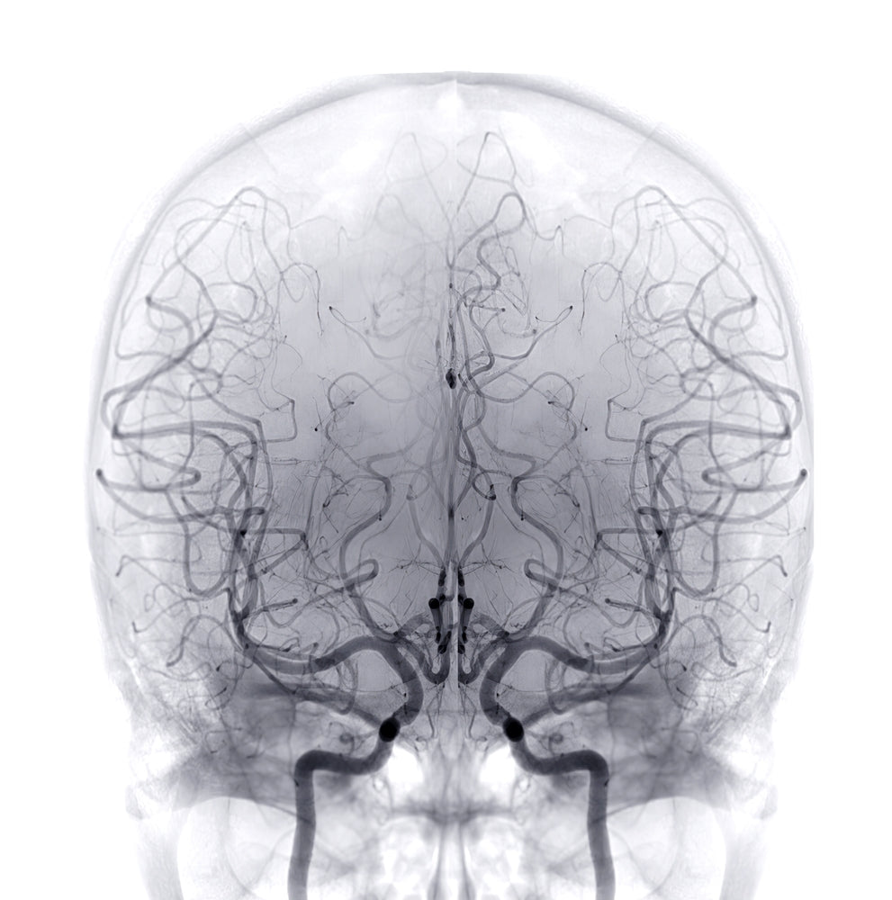 Brain Aneurysm Surgery