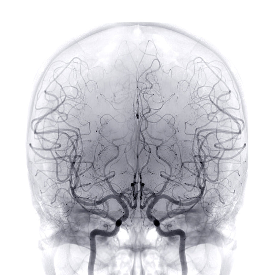 Brain Aneurysm Surgery