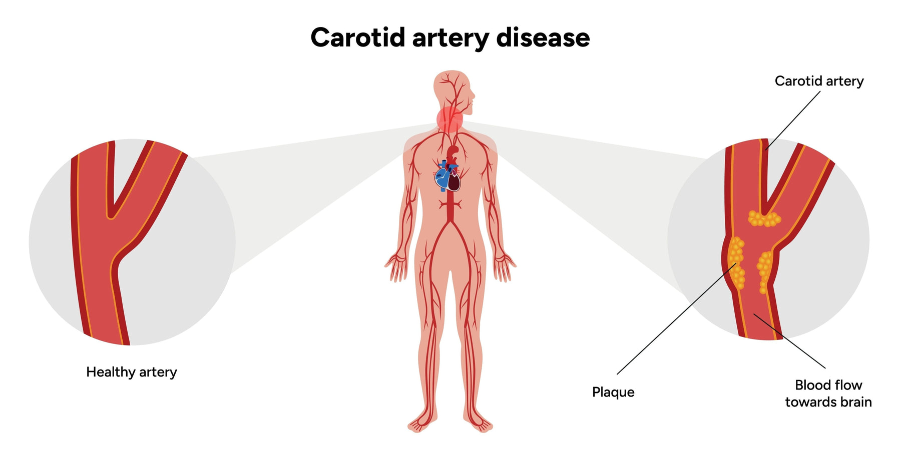 Carotid Artery Surgery: What Patients Really Experience Before and After