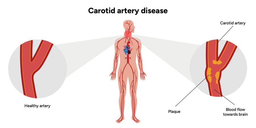 Carotid Artery Surgery: What Patients Really Experience Before and After