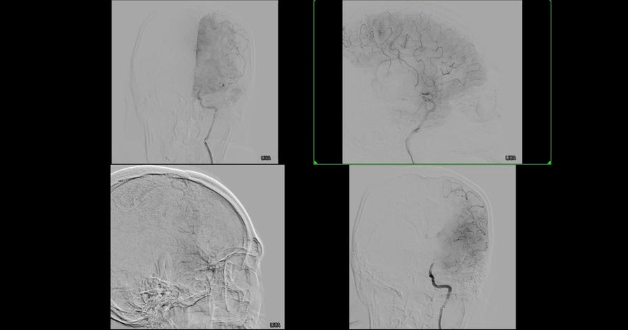 Cerebral Hemorrhage Surgery