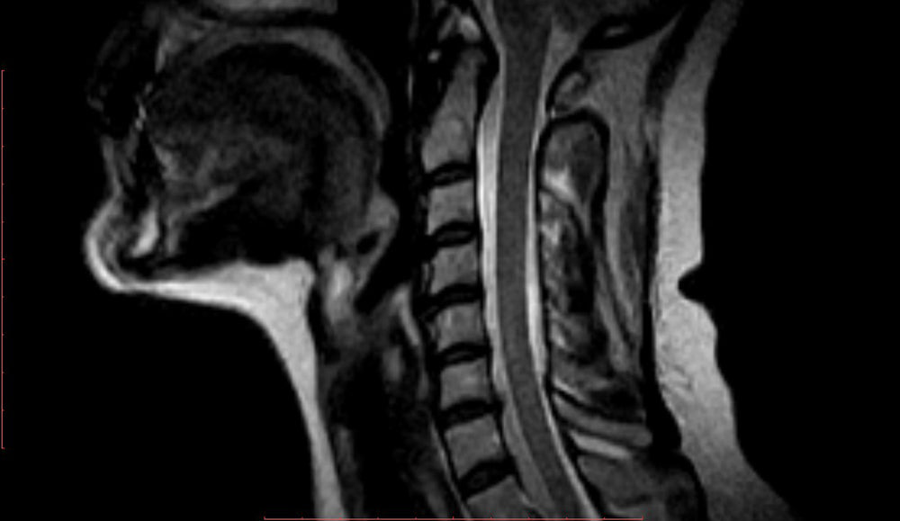 Cervical Disc Herniation Surgery