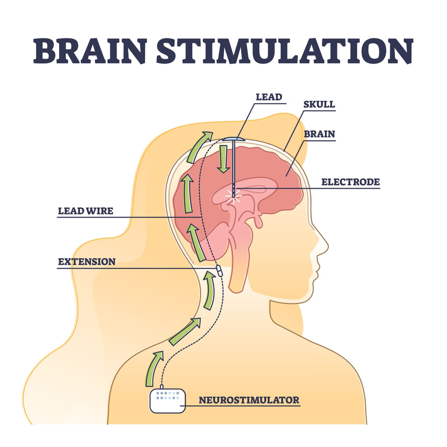 Deep Brain Stimulation (DBS)