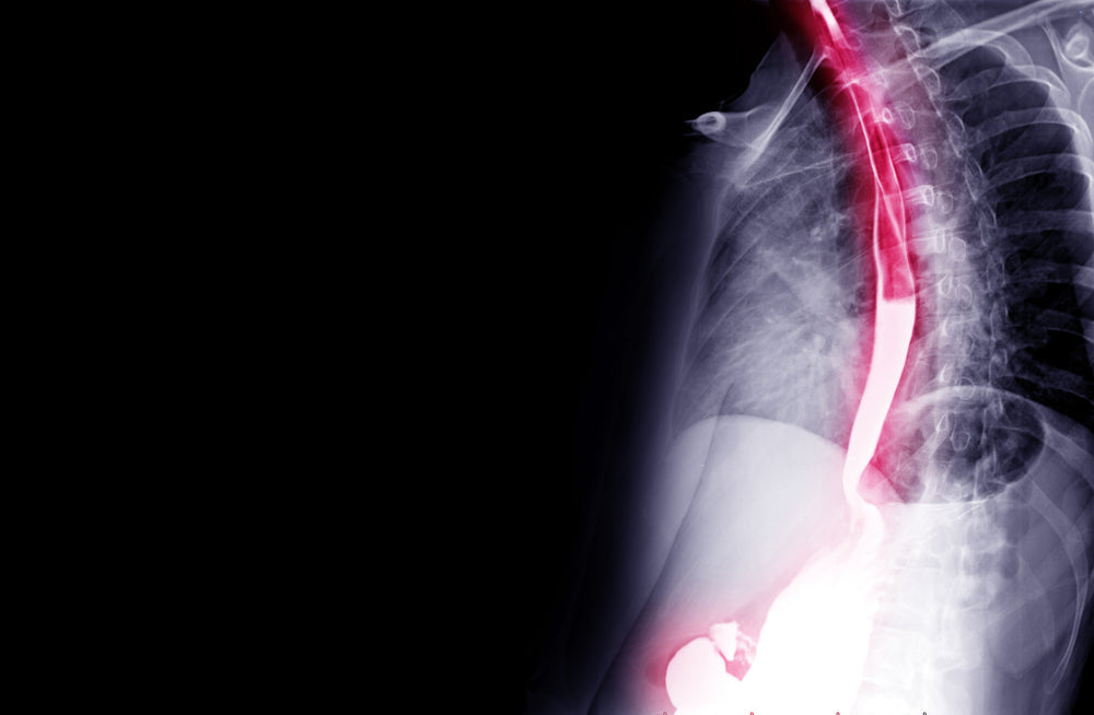 Esophageal Cancer Surgery