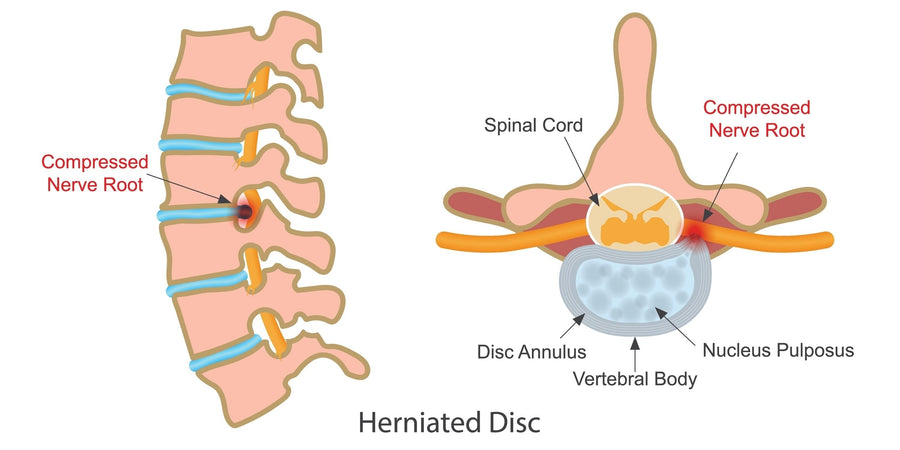 Herniated Disc Surgery