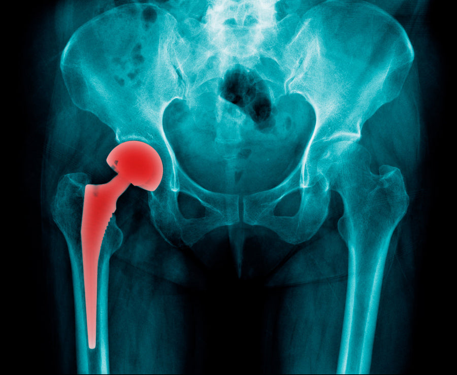 Hip Replacement Surgery