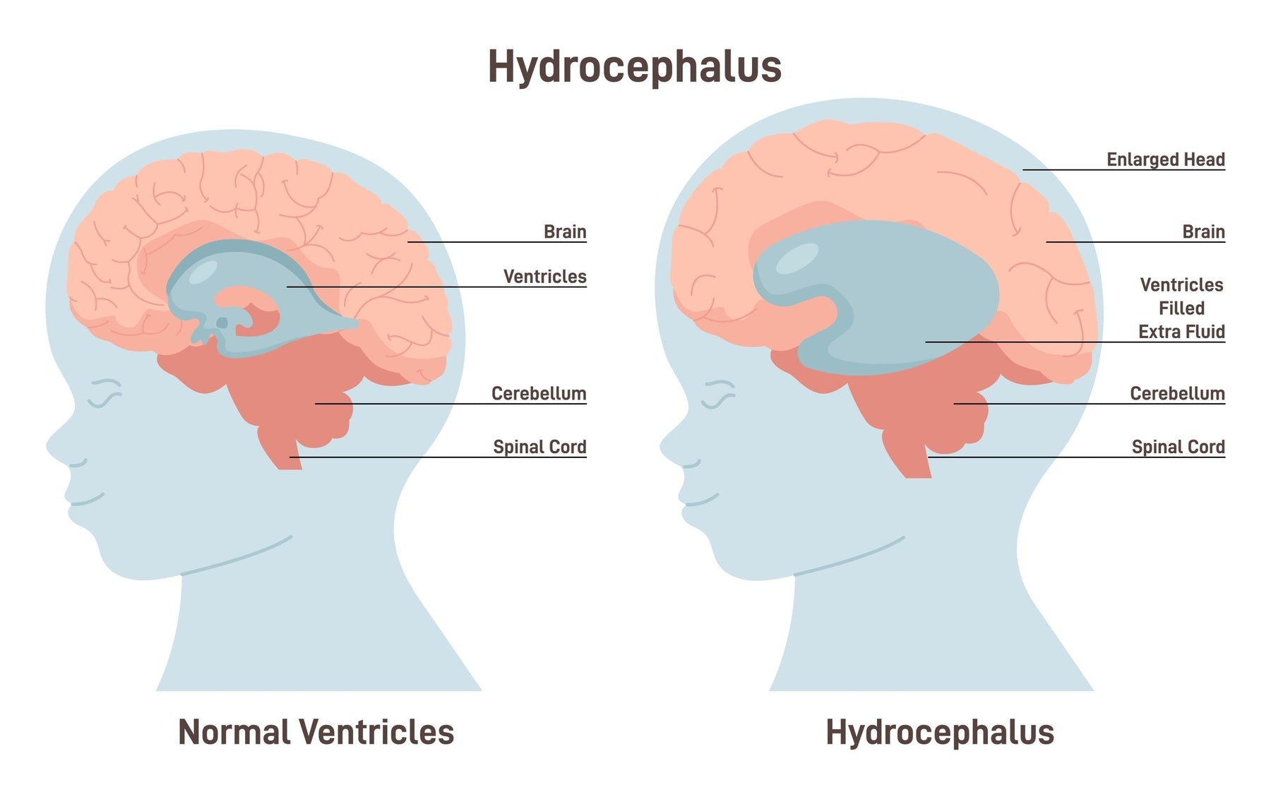 Hydrocephalus Shunt Surgery