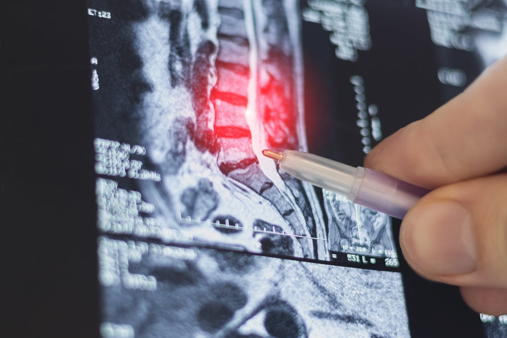 Lumbar Disc Herniation Surgery