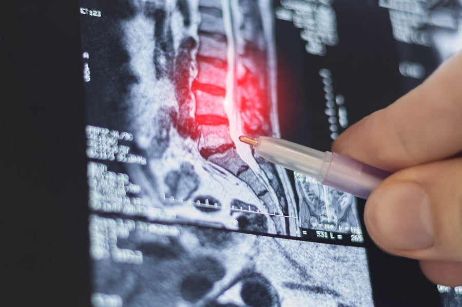 Lumbar Disc Herniation Surgery