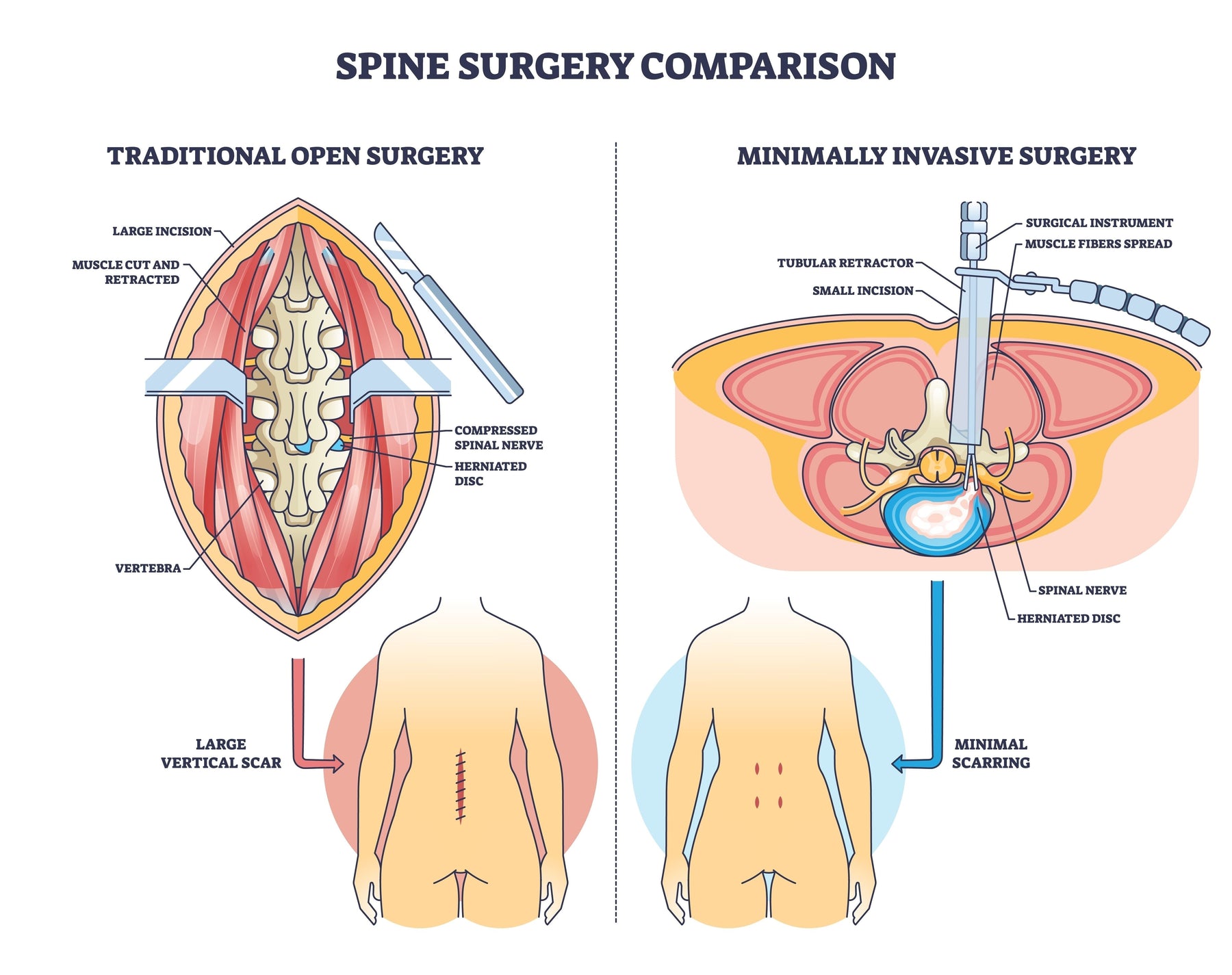 Minimally Invasive Spine Surgery