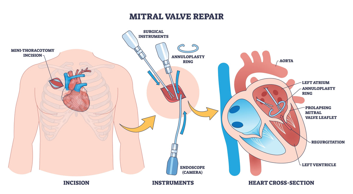 Mitral Valve Repair: What Patients Really Experience Before and After Surgery