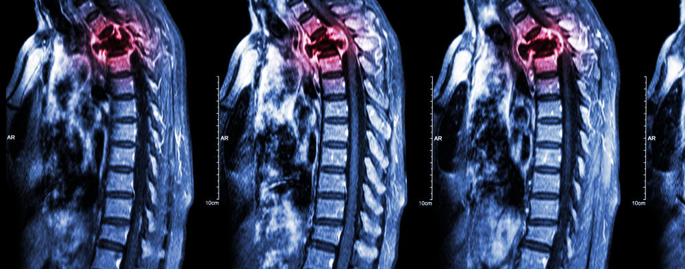 Orthopedic Oncology Surgery