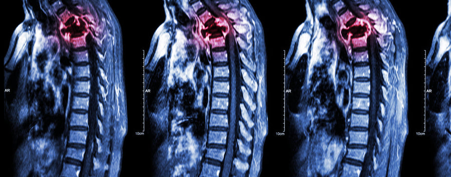 Orthopedic Oncology Surgery