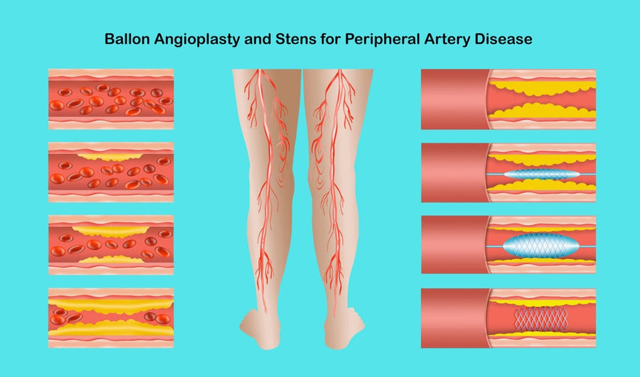 Peripheral Vascular Surgery: What Patients Really Experience Before and After