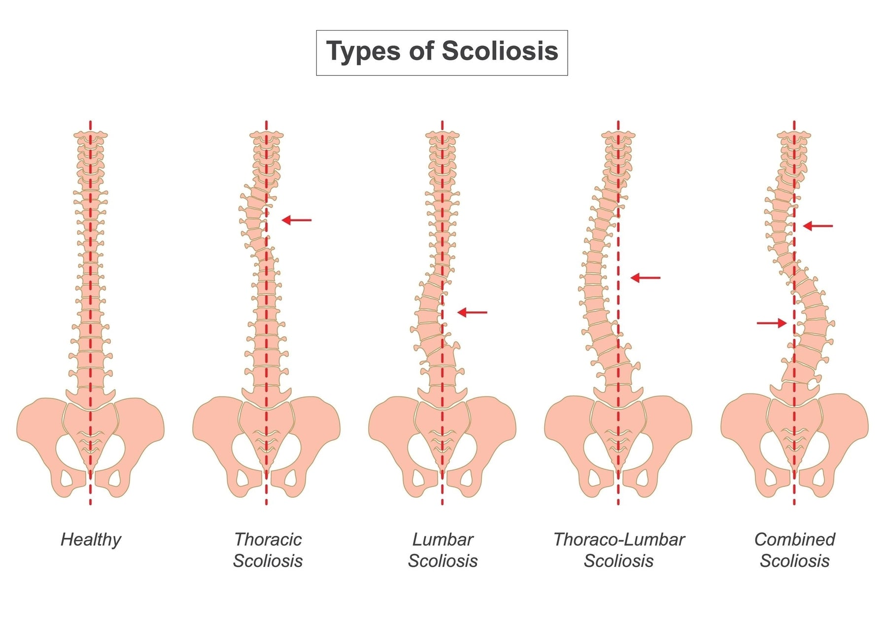 Scoliosis Surgery