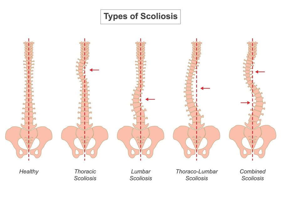 Scoliosis Surgery