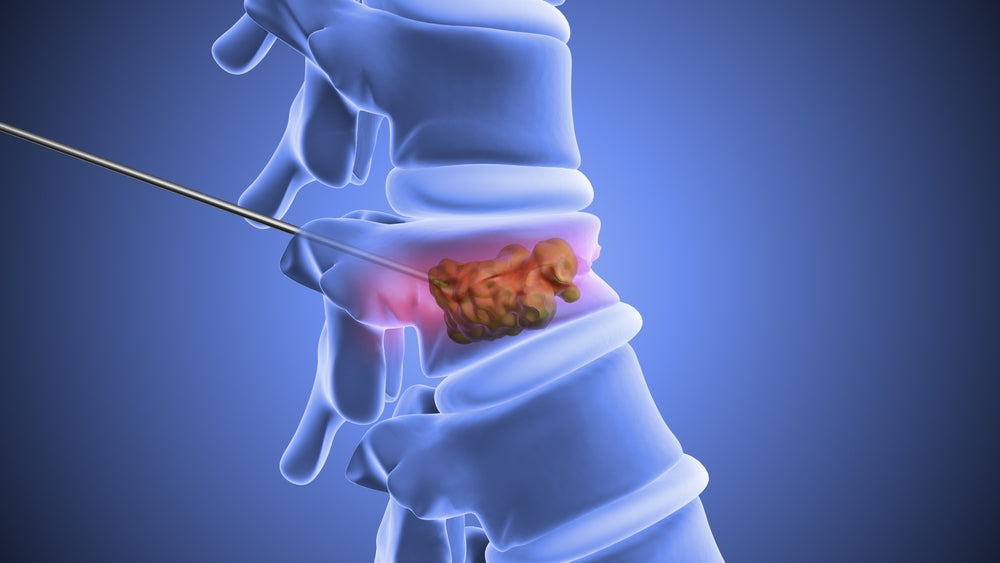 Spinal Cord Tumor Surgery