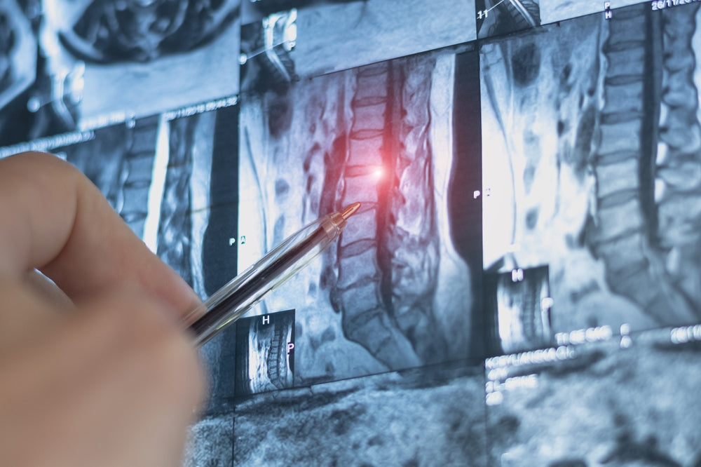 Spinal Tumor Surgery
