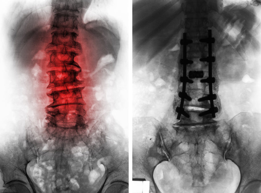Spondylolisthesis Surgery