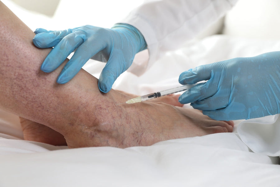 Varicose Vein Surgery: What Patients Really Experience Before and After Treatment